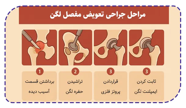 مراحل جراحی تعویض مفصل لگن