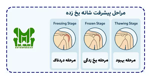 پیشرفت شانه یخ زده پیشرفت شانه یخ زده