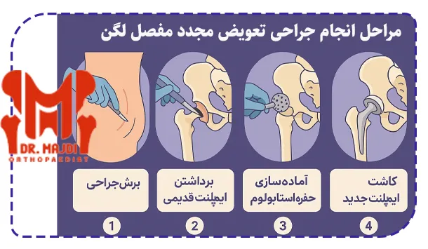 مراحل انجام جراحی تعویض مجدد مفصل لگن